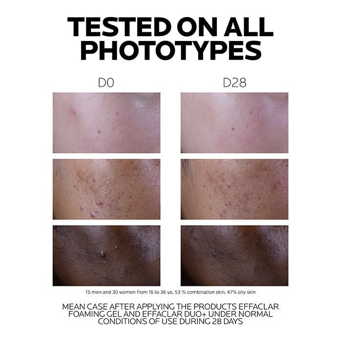 Results of Effaclar Duo+M Anti Blemish Moisturiser after 28 days on three skin phototypes