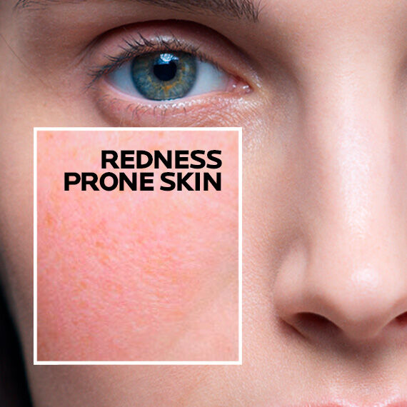 redness-prone