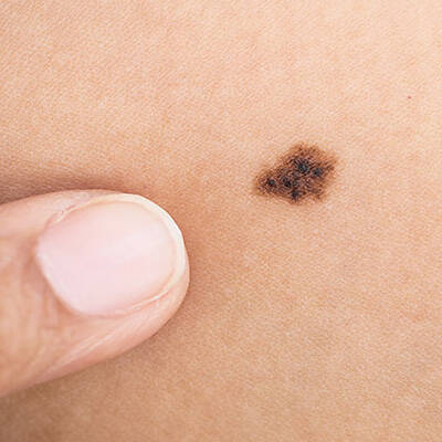 common moles