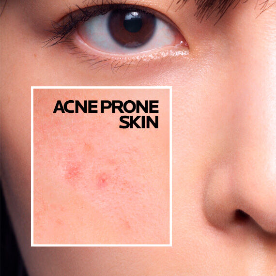 acne-prone