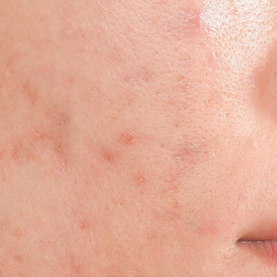 acne redness