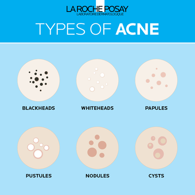 types of acne