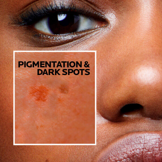 pigmentation-dark-spots