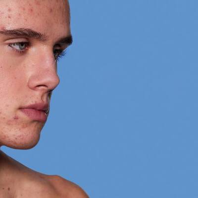 White are whiteheads?