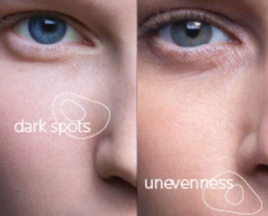 what-causes-dark-spots-how-to-fade-them