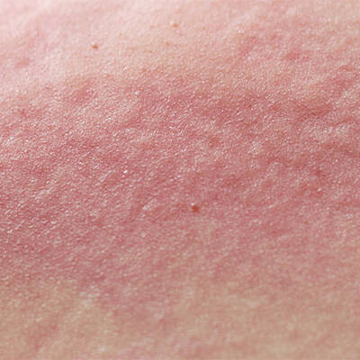 What Is Eczema?