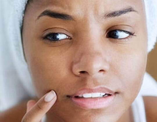 hormonal-acne-causes