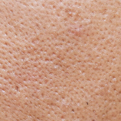 acne breakout
