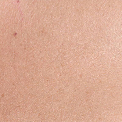 sun spots
