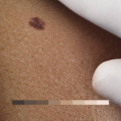 atypical moles