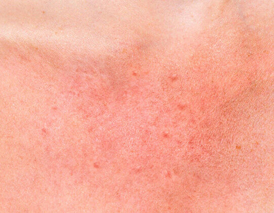 what-are-the-symptoms-of-a-skin-allergy