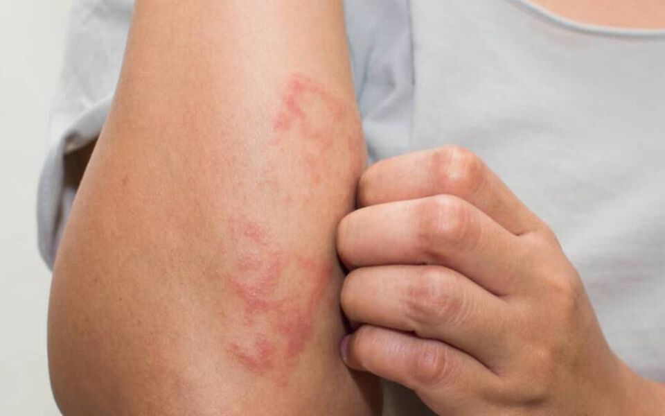 allergic reaction to la roche posay sunscreen