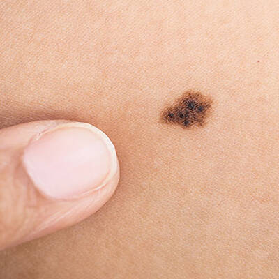 what does melanoma look like