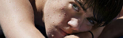 reduce acne