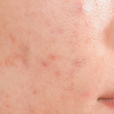 pimple redness