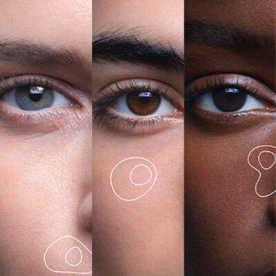 types of hyperpigmentation