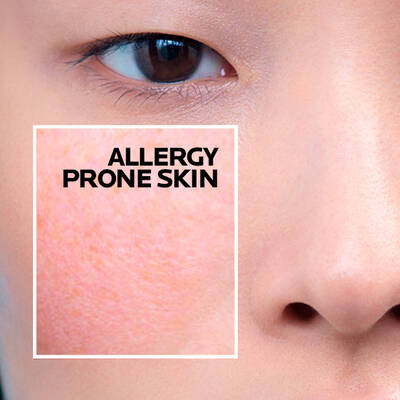 allergy-prone