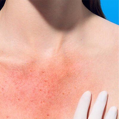 What Is Contact Dermatitis