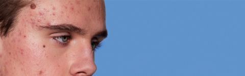 retinol vs retinoid