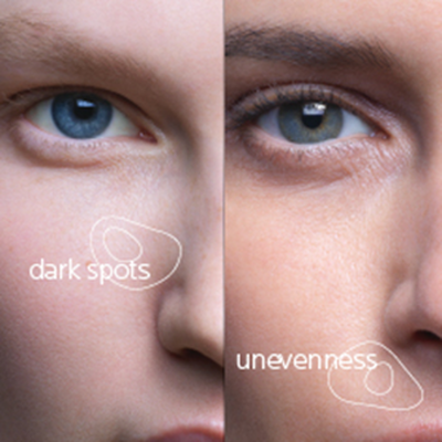 niacinamide for dark spots