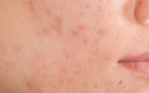 How To Remove The Redness Of A Pimple | Features | Rockdalenewtoncitizen.com