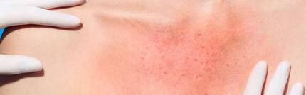 what are the symptoms of a skin allergy